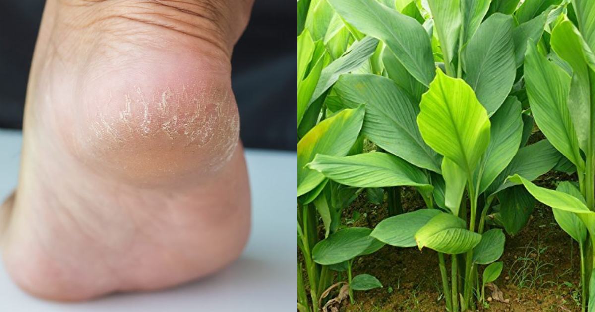 Home remedy for Cracked heel