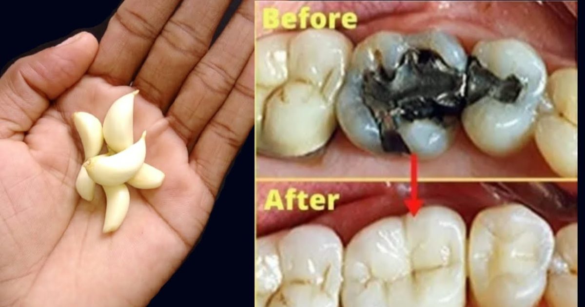 Toothache home remedies