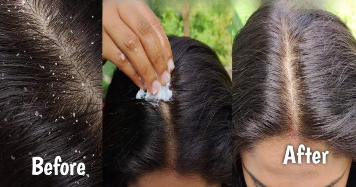 Dandruff remove 1 Wash Challenge