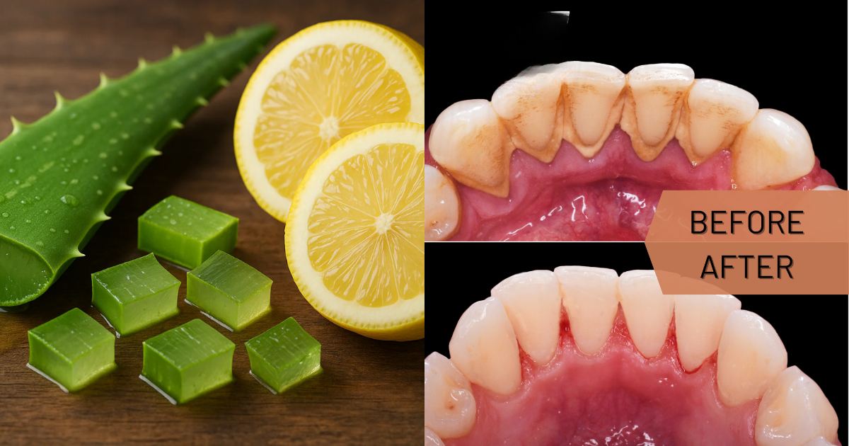 Dental plaques & teeth cleaning