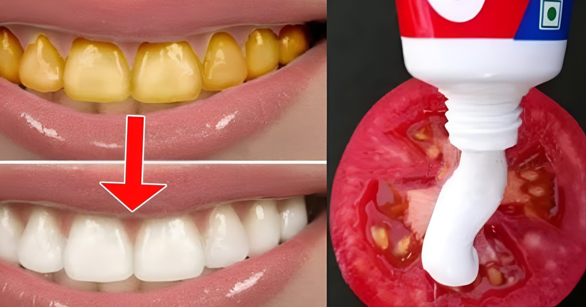 Teeth Yellow Stain Removal