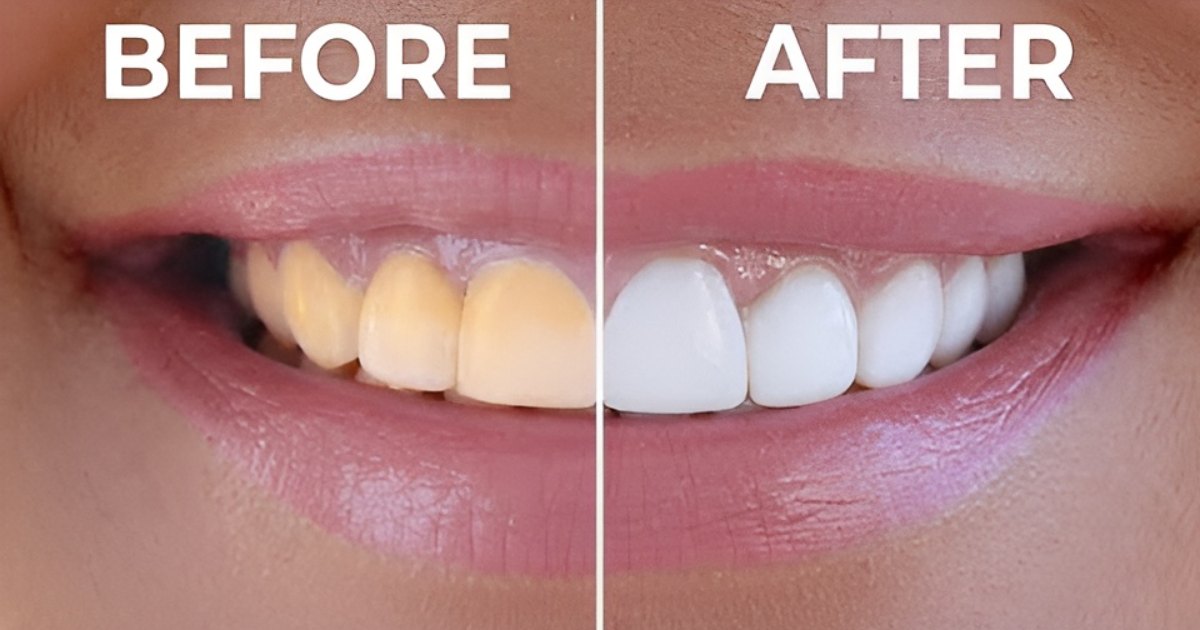 Yellow teeth solution