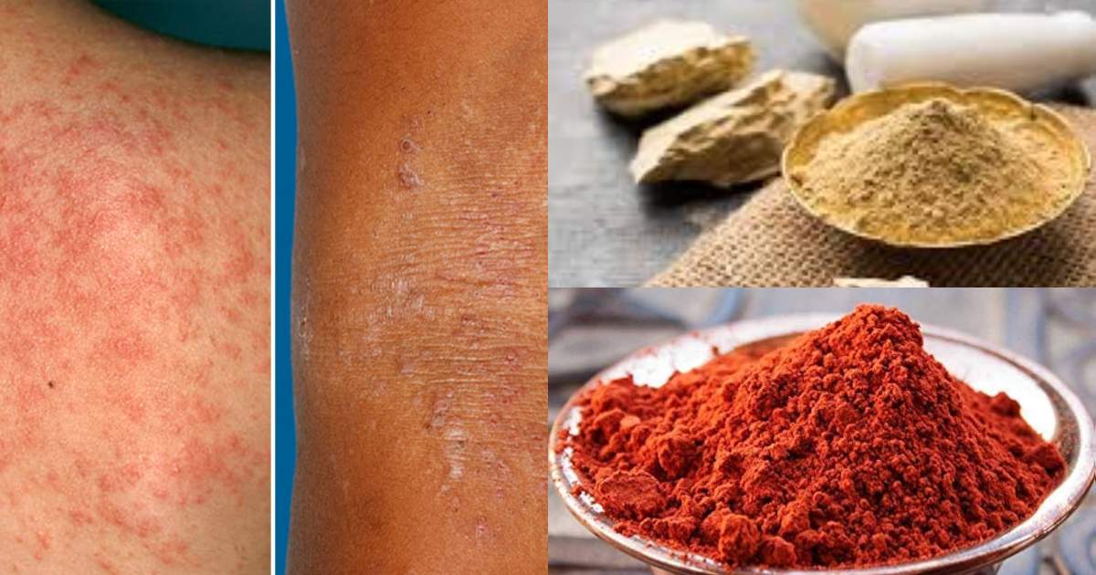 Heat rash remedy